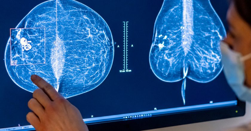 In contrast, the expert panel recommends breast cancer screening at age 40